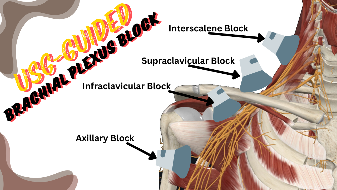 USG-guided brachial plexus block