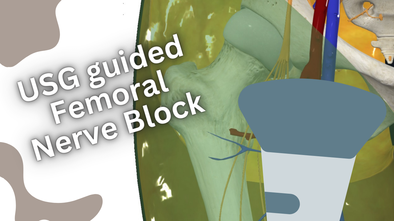 usg-guided Femoral Nerve Block