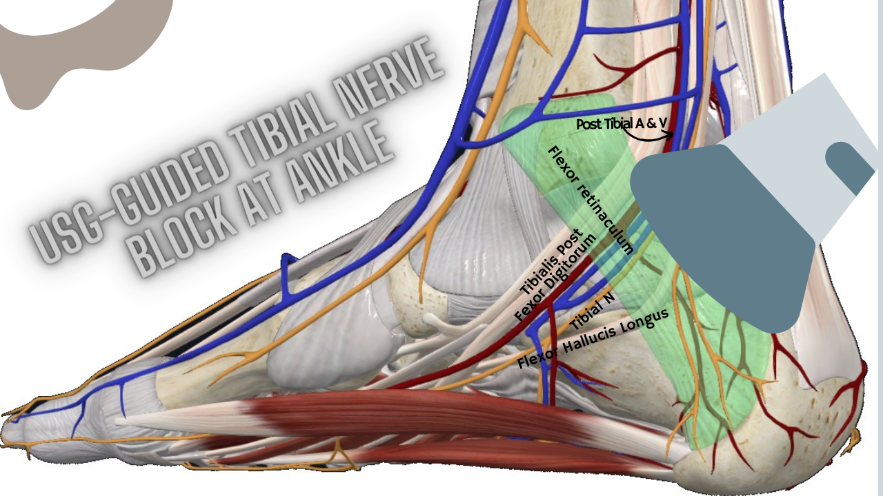 usg-guided tibial nerve block