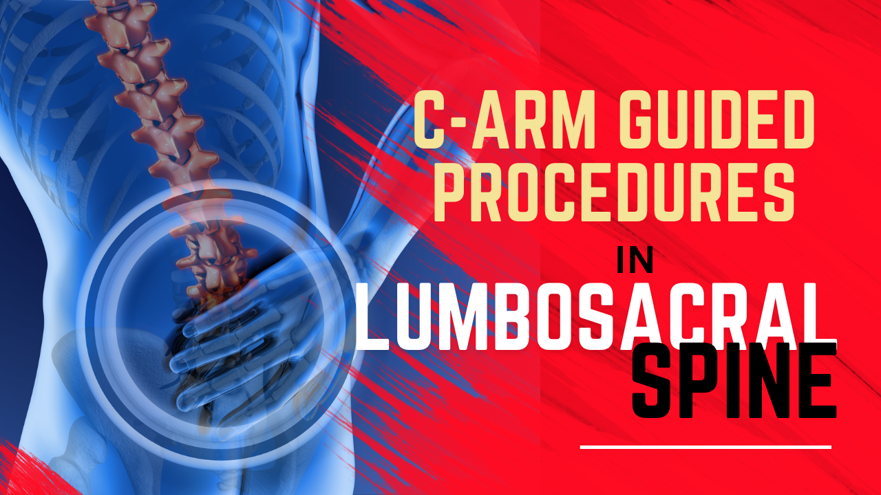 C-arm guided SPINE