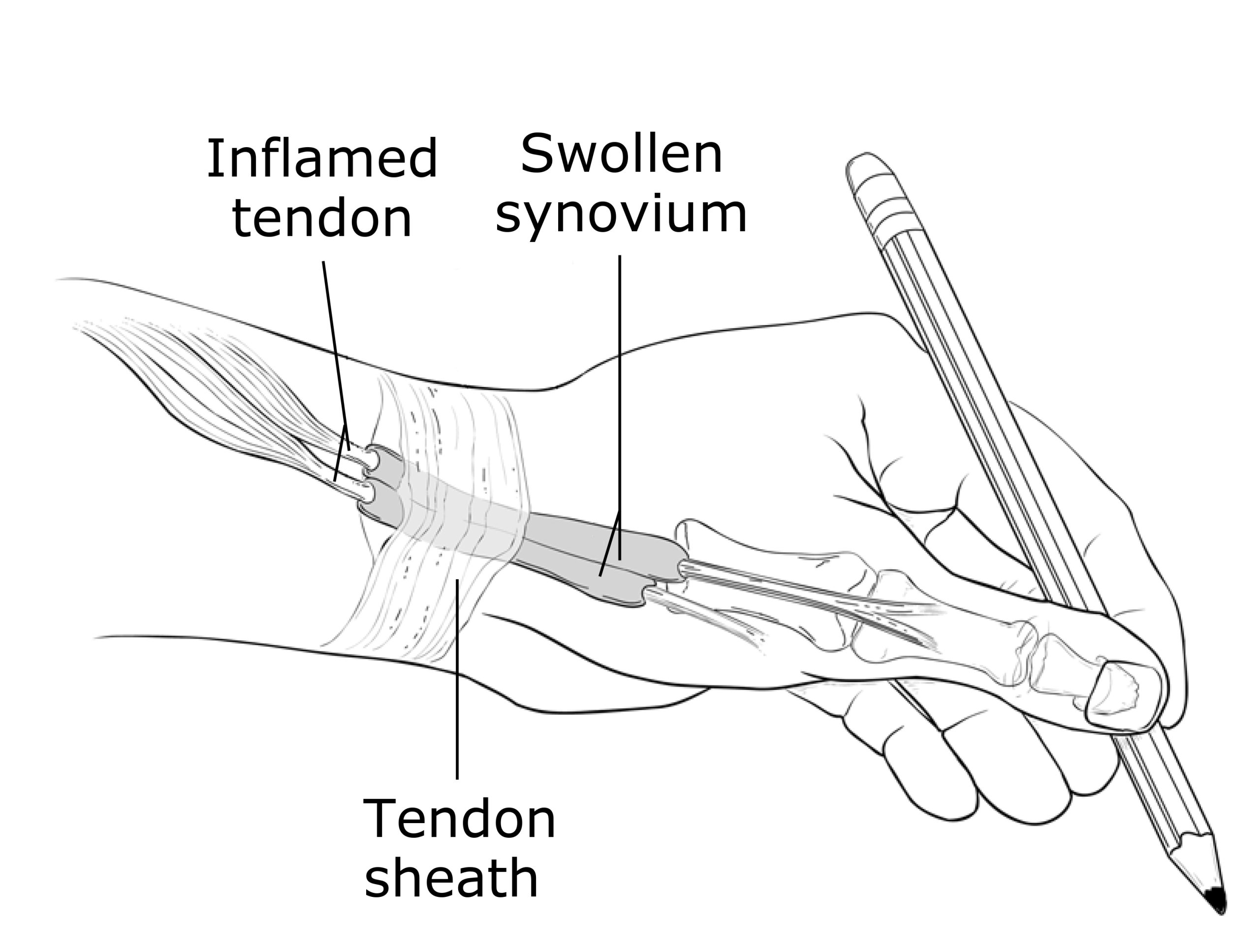 Anatomical illustration showing inflamed tendon sheath at the base of the thumb, characteristic of De Quervain's tenosynovitis, with labeled thumb and wrist tendons